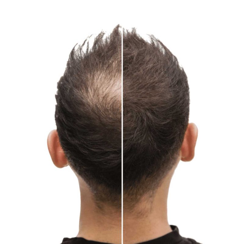 hd-fuer-maenner-haartherapie-vorher-nachher-komp